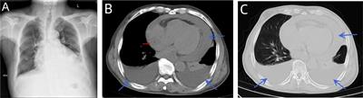 Primary cardiac tumor: a case report of right atrial angiosarcoma and review of the literature
